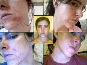 Melissa Gallico Before Pics (Cystic Acne)
